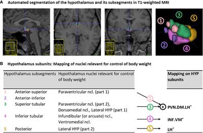 Lower hypothalamus subunit volumes link with impaired long-term body weight gain after preterm birth